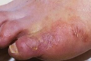 Manifestacións dunha infección por fungos na pel das pernas