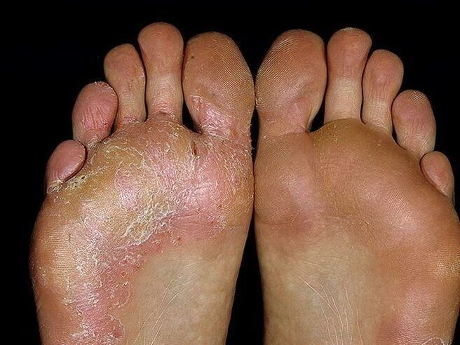 Síntomas dun fungo no pé