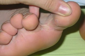 Lume entre os dedos dos pés