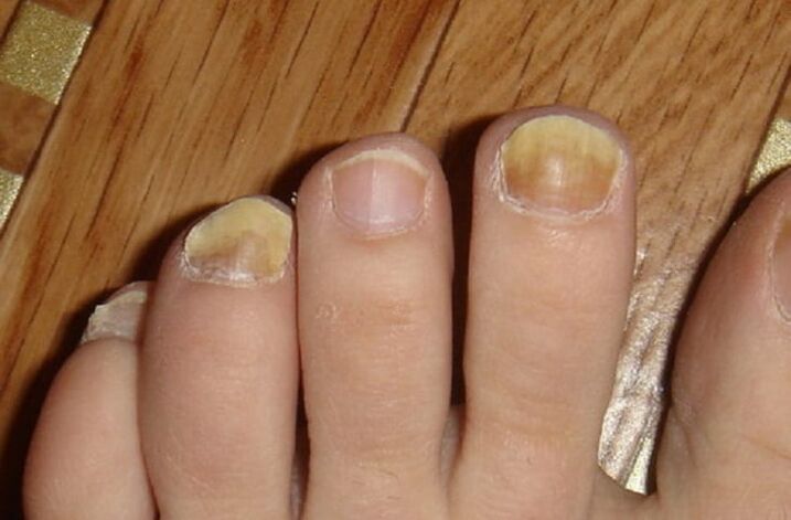 Síntomas de fungos nas uñas e na pel dos pés
